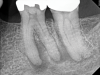 Fig 1. NSRCT can have high success, even with risk factors like periapical pathology associated, as depicted in this case presentation. Fig 1: Preoperative periapical radiograph showing AP. Fig 2: Preoperative CBCT. Fig 3: Immediate postoperative periapical radiograph. Fig 4: Three-month follow-up CBCT showing reduction of periapical radiolucency. Fig 5: One-year follow-up periapical radiograph showing resolution of periapical radiolucency.