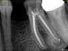 Fig 1 through Fig 5. NSRCT can have high success, even with risk factors like periapical pathology associated, as depicted in this case presentation. Fig 1: Preoperative periapical radiograph showing AP. Fig 2: Preoperative CBCT. Fig 3: Immediate postoperative periapical radiograph. Fig 4: Three-month follow-up CBCT showing reduction of periapical radiolucency. Fig 5: One-year follow-up periapical radiograph showing resolution of periapical radiolucency.