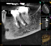 Fig 4. NSRCT can have high success, even with risk factors like periapical pathology associated, as depicted in this case presentation. Fig 1: Preoperative periapical radiograph showing AP. Fig 2: Preoperative CBCT. Fig 3: Immediate postoperative periapical radiograph. Fig 4: Three-month follow-up CBCT showing reduction of periapical radiolucency. Fig 5: One-year follow-up periapical radiograph showing resolution of periapical radiolucency.