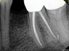 Fig 5. NSRCT can have high success, even with risk factors like periapical pathology associated, as depicted in this case presentation. Fig 1: Preoperative periapical radiograph showing AP. Fig 2: Preoperative CBCT. Fig 3: Immediate postoperative periapical radiograph. Fig 4: Three-month follow-up CBCT showing reduction of periapical radiolucency. Fig 5: One-year follow-up periapical radiograph showing resolution of periapical radiolucency.