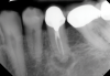 Fig 6. Identifiable inadequate NSRCT is associated with predictable RETX. Fig 6: Preoperative periapical radiograph showing AP, tooth No. 20. Fig 7. Postoperative periapical radiograph. Fig 8. Six-month follow-up periapical radiograph showing a significant decrease in size of the AP.