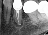 Fig 7. Identifiable inadequate NSRCT is associated with predictable RETX. Fig 6: Preoperative periapical radiograph showing AP, tooth No. 20. Fig 7. Postoperative periapical radiograph. Fig 8. Six-month follow-up periapical radiograph showing a significant decrease in size of the AP.