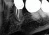 Fig 8. Identifiable inadequate NSRCT is associated with predictable RETX. Fig 6: Preoperative periapical radiograph showing AP, tooth No. 20. Fig 7. Postoperative periapical radiograph. Fig 8. Six-month follow-up periapical radiograph showing a significant decrease in size of the AP.