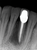 Fig 9 and Fig 10. Modern microsurgical techniques enhance the success rate of surgical retreatment through improved magnification, illumination, and the creation of optimal preparation and root-end filling. Fig 9: Postoperative periapical radiograph following apical surgery. Fig 10: Periapical radiograph at 18-month follow-up showing bony healing.