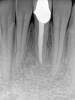 Fig 10. Modern microsurgical techniques enhance the success rate of surgical retreatment through improved magnification, illumination, and the creation of optimal preparation and root-end filling. Fig 9: Postoperative periapical radiograph following apical surgery. Fig 10: Periapical radiograph at 18-month follow-up showing bony healing.