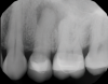 Fig 1. Case 1. Preoperative periapical radiograph showing periapical pathology associated with tooth No. 13.