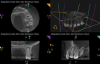 Fig 2. Preoperative CBCT. Note periapical pathology associated with tooth No. 13 communicating with the adjacent maxillary sinus along with associated mucositis.