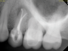 Fig 3. Immediate postoperative periapical radiograph.