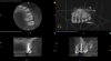 Fig 4. One-year recall CBCT. Note resolution of prior periapical pathology on tooth No. 13, sinus communication, and MSEO.