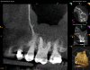 Fig 7 and Fig 8. Preoperative CBCT scans showing evidence of periapical pathology on tooth No. 14 as well as communication with the adjacent maxillary sinus and associated mucositis. Fig 7: Sagittal view, buccal roots No. 14. Fig 8: Sagittal view, palatal root No. 14.