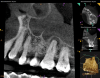 Fig 8. Preoperative CBCT scans showing evidence of periapical pathology on tooth No. 14 as well as communication with the adjacent maxillary sinus and associated mucositis. Fig 7: Sagittal view, buccal roots No. 14. Fig 8: Sagittal view, palatal root No. 14.