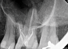 Fig 9. Case 2, cont’d. Immediate postoperative periapical imaging.