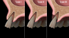 Fig 3. Socket types and their potential for immediate placement. Type I: Bony socket is intact; soft-tissue form is undisturbed. Type II: Bone loss is present in the coronal aspect of the socket; soft tissue remains intact and undisturbed. Type III: Bony defects exist in conjunction with a soft-tissue deformity.