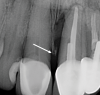 Fig 4. Radiograph of teeth Nos. 8 and 9. After tooth No. 9 is extracted, the height of the papilla will depend on the height of the bone on the mesial side of tooth No. 8, not the implant side of an interdental area. The arrow indicates the mesial osseous crest on tooth No. 8.