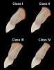 Fig 5. Sagittal root section classification. Class I: The root is close to the labial cortical plate of bone, but there is adequate bone to place an implant palatally. Class II: The root is in the middle of the alveolar ridge and not too close to the labial or palatal cortical plates of bone; an implant may be carefully inserted into the alveolar socket. Class III: The root is too close to the palatal cortical plate for immediate implant placement. Class IV: The root is too close to both the palatal and buccal cortical plates to place an immediate implant.