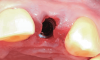 Fig 7. A case (Fig 7 through Fig 16) is presented demonstrating construction of a fixed provisional temporary crown at site No. 10, beginning with an implant placed at the site.