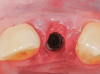 Fig 13. The healing abutment is removed.