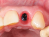 Fig 15. The provisional crown removed to demonstrate the ideal appearance of the soft-tissue contour prior to permanent crown insertion.