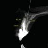 Fig 4. Diagnostics measurements include alveolar bone height, root length in the bone, and distance from the gingival margin to the buccal bone level.