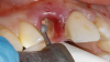 Fig 5. SPOT Step 1: After the clinical crown is removed, a high-speed diamond bur (Meisinger 801H-029) is used to hollow out the center of the tooth 2 mm to 3 mm subgingivally leaving a 1 mm rim of dentin around the root circumference.