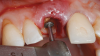 Fig 6. SPOT Step 2: The restorative zone is established using a diamond wheel bur (Meisinger 909G-031) to flatten the root to bone level, working from inside to outside.