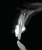 Fig 8. SPOT Step 3: Two pilot hole trajectories are drilled using a carbide bur (Meisinger HM162SX-014). The first pilot hole trajectory reaches the root apex, removing all root canal contents, including any filling materials. The second pilot hole trajectory establishes the implant osteotomy. (Figure 8 is a composite illustration provided by the authors.)