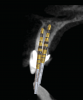 Fig 11. SPOT Step 4: Densah burs VT1525 (2.0) and VT1828 (2.3) are used at 1,200 rpm with irrigation in CW mode to widen the root canal hole trajectory to provide further and complete apex removal. The same burs are then used to establish the implant osteotomy. In some cases, the two trajectory holes might eventually overlap. (Figure 11 is a composite illustration provided by the authors.)