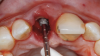 Fig 14. SPOT Step 5, cont’d: The palatal root section is gently removed, and the shield height is reduced to bone level approximately 2 mm to 3 mm subgingivally using a shaping bur (Megagen 3DD50). The shield thickness is reduced to 1.5 mm to 2 mm using a round diamond bur (Megagen 2DD3034, as shown); further shield thickness reduction could be finalized using a diamond shaping bur (Megagen 1DD1911). The coronal shield chamfer is created to allow for an “S”-shaped restorative space using a diamond chamfer shaping bur (Megagen GD40G).