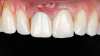 Fig 17. SPOT Step 7, cont’d: A screw-retained provisional restoration or custom-made healing abutment is placed to create a proper emergence profile. Passive fit should be confirmed with an x-ray.