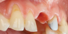 Fig 20. At 6 months postoperative, the right central incisor site demonstrated significant hard- and soft-tissue volume maintenance. The left central incisor tooth was prepared for a new restoration.