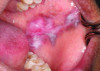 Fig 2. SLE-related oral lesions are seen on the buccal mucosa
(Fig 1, right buccal mucosa; Fig 2, left buccal mucosa) of a 25-yearold
male patient, who had a history of and was previously diagnosed
with SLE. The findings were reported by the oral pathologist who
provided the photographs (photographs courtesy of Iona Leong, BDS,
University of Toronto).