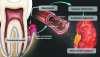 Fig 1. Depiction of how periodontitis may act as a potential cause of local and systemic inflammation in CKD patients. Legend: CRP = C-reactive protein; IL = interleukin; MMP = matrix metalloproteinasis; PGE2 = prostaglandin E2.