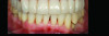 Fig 6. Results of SRP demonstrated resolution of inflammation and residual probing depths of 2 mm to 3 mm, 18 years after treatment of Case 1 patient.