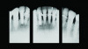 Fig 8. Initial radiograph of the Case 2 patient, teeth Nos. 22 through 27. Fig 9. SRP resulted in the elimination of inflammation and remaining probing depths of 2 mm to 3 mm in Case 2 patient, 3 months post-therapy. (Fig 4 through Fig 9 are courtesy of Dennis Tarnow, DDS.)