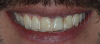 Fig 4. Digital smile design simulation.