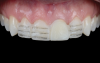 Fig 7. Intraoral mock-up as an index for veneer preparations.