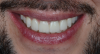 Fig 14. Close-up smile with final restorations.