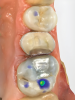 Fig 1 through Fig 5. Single-visit restoration of a maxillary second premolar following root canal treatment. Fig 1: Morphology-guided overlay preparation. Fig 2: IOS bite registration via imaging of buccal tooth surfaces. Fig 3: Preparation margin defined following IOS impression. Fig 4: Overlay design on the IOS platform, integrating adjacent tooth anatomy. Fig 5: Bonded overlay fabricated from CAD/CAM resin-based composite. Fig 6 through Fig 9. Digital workflow for guided endodontics using a digital twin, created by registering an IOI with CBCT data.