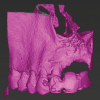 Fig 6: CBCT imaging of a maxillary lateral incisor requiring root canal treatment.