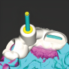 Fig 9: Virtual design of a custom guide equipped with a sleeve system to direct the bur, incorporating inspection windows to ensure accurate positioning and stability of the guide on the dental arch.