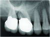 Fig 1. Examples of multirooted teeth showing periradicular periodontitis and loss of periradicular bone support isolated to one root (indicated by red arrows). Fig 1: Tooth No. 3 distobuccal root with circumferential bone loss from the crestal bone height to the apex with stable mesiobuccal and palatal roots. Fig 2: Tooth No. 30 with a prior apical surgery showing bone loss surrounding a fractured mesial root. Fig 3: Tooth No. 19 with lateral and apical bone loss regions affecting a fractured mesial root. Fig 4: 3D CBCT imaging of tooth No. 3 depicting an apicomarginal bone loss defect affecting the mesiobuccal root with stable fused distobuccal and palatal roots.