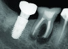 Fig 2. Examples of multirooted teeth showing periradicular periodontitis and loss of periradicular bone support isolated to one root (indicated by red arrows). Fig 1: Tooth No. 3 distobuccal root with circumferential bone loss from the crestal bone height to the apex with stable mesiobuccal and palatal roots. Fig 2: Tooth No. 30 with a prior apical surgery showing bone loss surrounding a fractured mesial root. Fig 3: Tooth No. 19 with lateral and apical bone loss regions affecting a fractured mesial root. Fig 4: 3D CBCT imaging of tooth No. 3 depicting an apicomarginal bone loss defect affecting the mesiobuccal root with stable fused distobuccal and palatal roots.