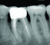 Fig 1 through Fig 4. Examples of multirooted teeth showing periradicular periodontitis and loss of periradicular bone support isolated to one root (indicated by red arrows). Fig 1: Tooth No. 3 distobuccal root with circumferential bone loss from the crestal bone height to the apex with stable mesiobuccal and palatal roots. Fig 2: Tooth No. 30 with a prior apical surgery showing bone loss surrounding a fractured mesial root. Fig 3: Tooth No. 19 with lateral and apical bone loss regions affecting a fractured mesial root. Fig 4: 3D CBCT imaging of tooth No. 3 depicting an apicomarginal bone loss defect affecting the mesiobuccal root with stable fused distobuccal and palatal roots.