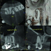 Fig 4. Examples of multirooted teeth showing periradicular periodontitis and loss of periradicular bone support isolated to one root (indicated by red arrows). Fig 1: Tooth No. 3 distobuccal root with circumferential bone loss from the crestal bone height to the apex with stable mesiobuccal and palatal roots. Fig 2: Tooth No. 30 with a prior apical surgery showing bone loss surrounding a fractured mesial root. Fig 3: Tooth No. 19 with lateral and apical bone loss regions affecting a fractured mesial root. Fig 4: 3D CBCT imaging of tooth No. 3 depicting an apicomarginal bone loss defect affecting the mesiobuccal root with stable fused distobuccal and palatal roots.