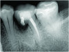 Fig 5. A cleansable resected root surface, the root filling, and the root contour will affect the prognosis. Fig 5: Tooth No. 19 at 1-year post-treatment with a remaining stub of the mesial root following root resection; note a subsequent larger-than-expected crestal bone loss defect below the cantilevered portion of the tooth. Incomplete resection and lack of proper contour toward the mesial contact has created a plaque trap and subsequent unstable periodontal status. This problem can be avoided with a more aggressive resection to ensure a cleansable situation. Fig 6: Clinical image of tooth No. 14 with a resected mesiobuccal root and RMGI restoration of the underside of the tooth. The resultant contour has no lips or ridges and has a smooth transition to the mesial contact space; there is also a smooth transition to the remaining distobuccal and palatal roots, creating a cleansable situation. Fig 7: Tooth No. 18 immediately following resection of the mesial root demonstrates a contoured mesial surface that smoothly blends to the mesial contact region. The underside of the cantilevered portion of the tooth is restored with a RMGI restoration, and the socket is grafted with an allograft. 
Fig 8: Tooth No. 30 with a resected mesial root and restoration of the underside with a RMGI restoration at 5 years post-treatment is displaying the expected healing pattern of the crestal bone following grafting of the socket. The proper resection and contouring permits adequate maintenance and resultant stability of the tooth.