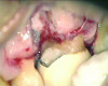 Fig 6. A cleansable resected root surface, the root filling, and the root contour will affect the prognosis. Fig 5: Tooth No. 19 at 1-year post-treatment with a remaining stub of the mesial root following root resection; note a subsequent larger-than-expected crestal bone loss defect below the cantilevered portion of the tooth. Incomplete resection and lack of proper contour toward the mesial contact has created a plaque trap and subsequent unstable periodontal status. This problem can be avoided with a more aggressive resection to ensure a cleansable situation. Fig 6: Clinical image of tooth No. 14 with a resected mesiobuccal root and RMGI restoration of the underside of the tooth. The resultant contour has no lips or ridges and has a smooth transition to the mesial contact space; there is also a smooth transition to the remaining distobuccal and palatal roots, creating a cleansable situation. Fig 7: Tooth No. 18 immediately following resection of the mesial root demonstrates a contoured mesial surface that smoothly blends to the mesial contact region. The underside of the cantilevered portion of the tooth is restored with a RMGI restoration, and the socket is grafted with an allograft. 
Fig 8: Tooth No. 30 with a resected mesial root and restoration of the underside with a RMGI restoration at 5 years post-treatment is displaying the expected healing pattern of the crestal bone following grafting of the socket. The proper resection and contouring permits adequate maintenance and resultant stability of the tooth.