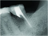 Fig 7. A cleansable resected root surface, the root filling, and the root contour will affect the prognosis. Fig 5: Tooth No. 19 at 1-year post-treatment with a remaining stub of the mesial root following root resection; note a subsequent larger-than-expected crestal bone loss defect below the cantilevered portion of the tooth. Incomplete resection and lack of proper contour toward the mesial contact has created a plaque trap and subsequent unstable periodontal status. This problem can be avoided with a more aggressive resection to ensure a cleansable situation. Fig 6: Clinical image of tooth No. 14 with a resected mesiobuccal root and RMGI restoration of the underside of the tooth. The resultant contour has no lips or ridges and has a smooth transition to the mesial contact space; there is also a smooth transition to the remaining distobuccal and palatal roots, creating a cleansable situation. Fig 7: Tooth No. 18 immediately following resection of the mesial root demonstrates a contoured mesial surface that smoothly blends to the mesial contact region. The underside of the cantilevered portion of the tooth is restored with a RMGI restoration, and the socket is grafted with an allograft. 
Fig 8: Tooth No. 30 with a resected mesial root and restoration of the underside with a RMGI restoration at 5 years post-treatment is displaying the expected healing pattern of the crestal bone following grafting of the socket. The proper resection and contouring permits adequate maintenance and resultant stability of the tooth.