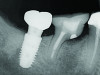 Fig 8. A cleansable resected root surface, the root filling, and the root contour will affect the prognosis. Fig 5: Tooth No. 19 at 1-year post-treatment with a remaining stub of the mesial root following root resection; note a subsequent larger-than-expected crestal bone loss defect below the cantilevered portion of the tooth. Incomplete resection and lack of proper contour toward the mesial contact has created a plaque trap and subsequent unstable periodontal status. This problem can be avoided with a more aggressive resection to ensure a cleansable situation. Fig 6: Clinical image of tooth No. 14 with a resected mesiobuccal root and RMGI restoration of the underside of the tooth. The resultant contour has no lips or ridges and has a smooth transition to the mesial contact space; there is also a smooth transition to the remaining distobuccal and palatal roots, creating a cleansable situation. Fig 7: Tooth No. 18 immediately following resection of the mesial root demonstrates a contoured mesial surface that smoothly blends to the mesial contact region. The underside of the cantilevered portion of the tooth is restored with a RMGI restoration, and the socket is grafted with an allograft. 
Fig 8: Tooth No. 30 with a resected mesial root and restoration of the underside with a RMGI restoration at 5 years post-treatment is displaying the expected healing pattern of the crestal bone following grafting of the socket. The proper resection and contouring permits adequate maintenance and resultant stability of the tooth.