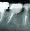 Fig 9. While grafting can be placed into a socket at a level that is in contact with the cantilevered portion of the tooth (Fig 9), over time the crestal bone level is expected to stabilize 1 mm to 3 mm below the cantilevered section (Fig 10).