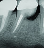 Fig 10. While grafting can be placed into a socket at a level that is in contact with the cantilevered portion of the tooth (Fig 9), over time the crestal bone level is expected to stabilize 1 mm to 3 mm below the cantilevered section (Fig 10).